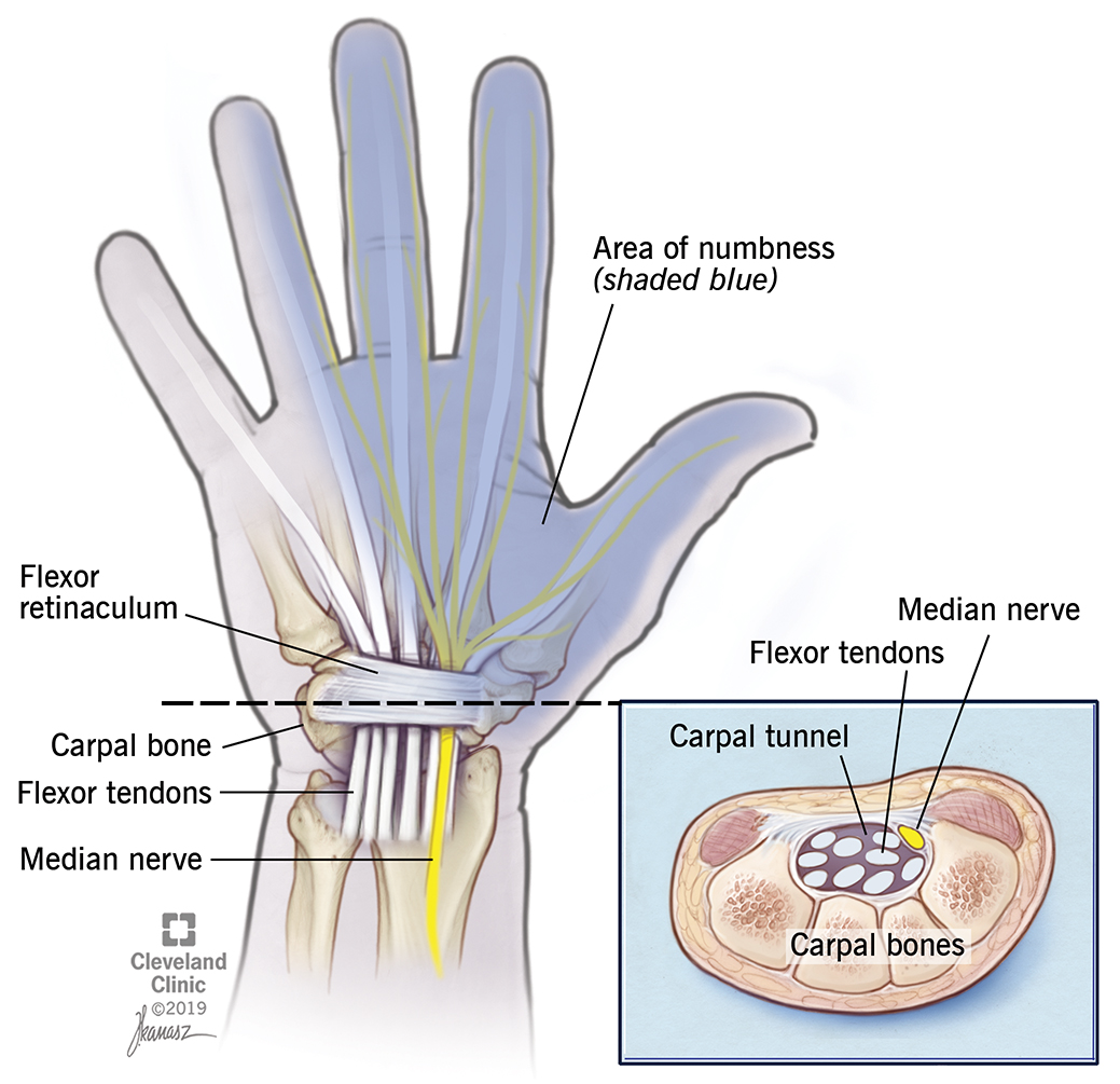 chiropractic-and-carpal-tunnel-syndrome-mg-dodge-chiropractic